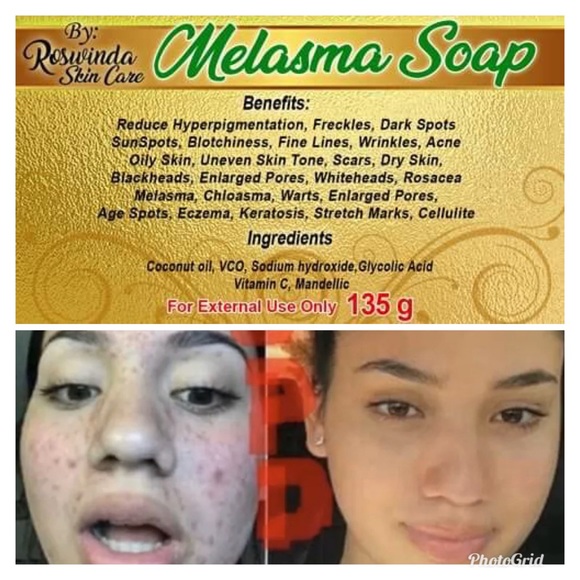roswinda melasma soap